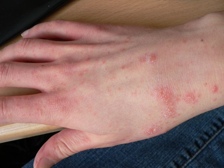 Scabies Contagious Period Cdc