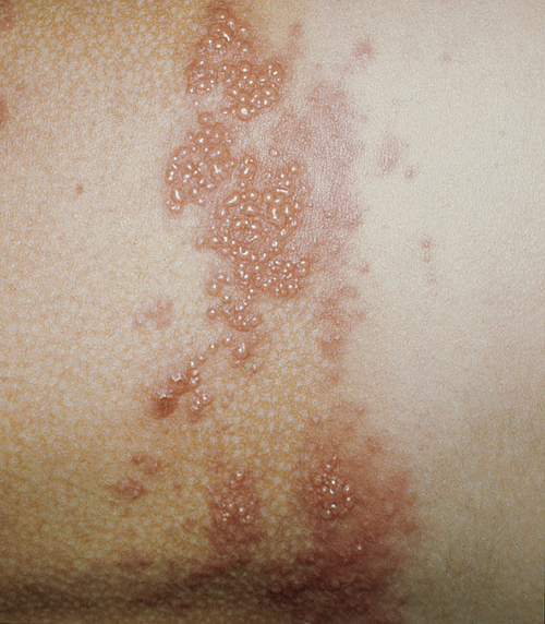 An scheide herpes der herpes in