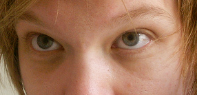cropped from English: Example of dark circles