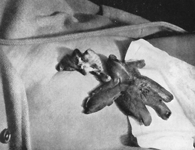 A mão de um "espírito" da médium Mina Crandon que foi descoberta como evento fraudulento, 1923. Biólogos examinaram a mão e descobriram que era esculpida de um pedaço de fígado animal