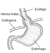 Esquema de hernia de hiato.gif