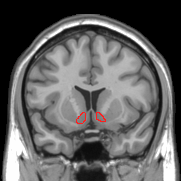 Coronal MRI image showing Nucleus accumbens ci...