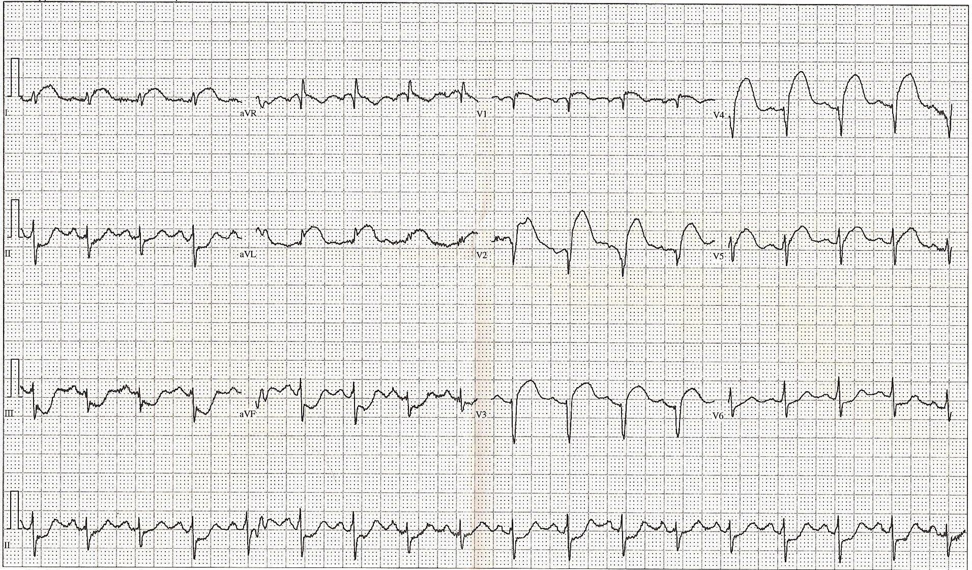 Anterior Stemi Ekg