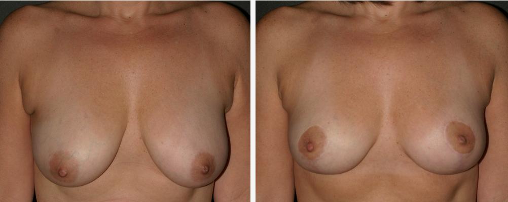 Breast Reduction Pictures By Size