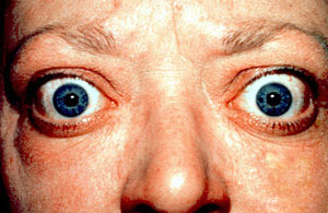 Proptosis and lid retraction from Graves' Disease.jpg