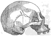 Representació del prototip de cervell d'esquimal segons la classificació etnoracial de Josiah Clark Nott i George Robins.