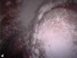 Злокачествен плеврален мезотелиом (видео асистиран торакоскопски изглед) (изрязан) .png