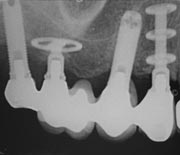 Picture of two cylindrical dental implants and...
