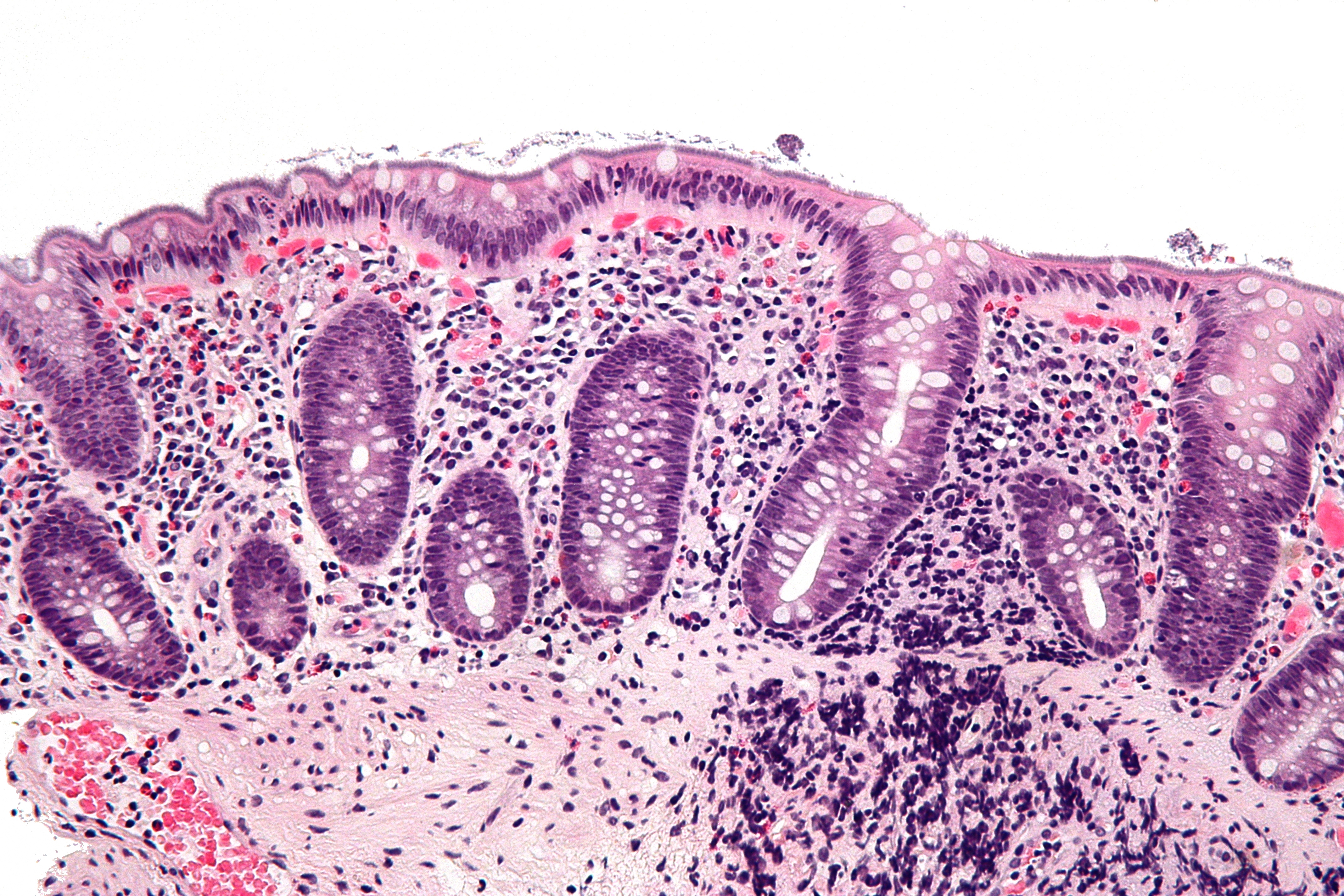 http://upload.wikimedia.org/wikipedia/commons/9/98/Intestinal_spirochetosis_-_high_mag.jpg