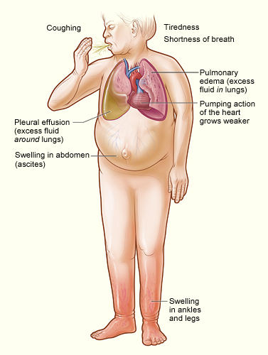 Symptoms Of Heart Not Getting Enough Blood