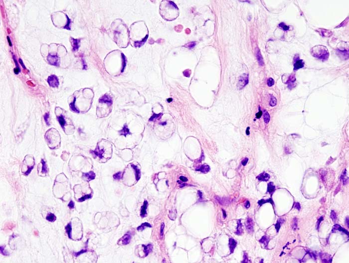 Myxoid Lipoma