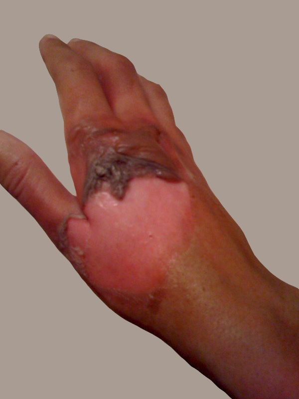 pictures of 2nd degree burns