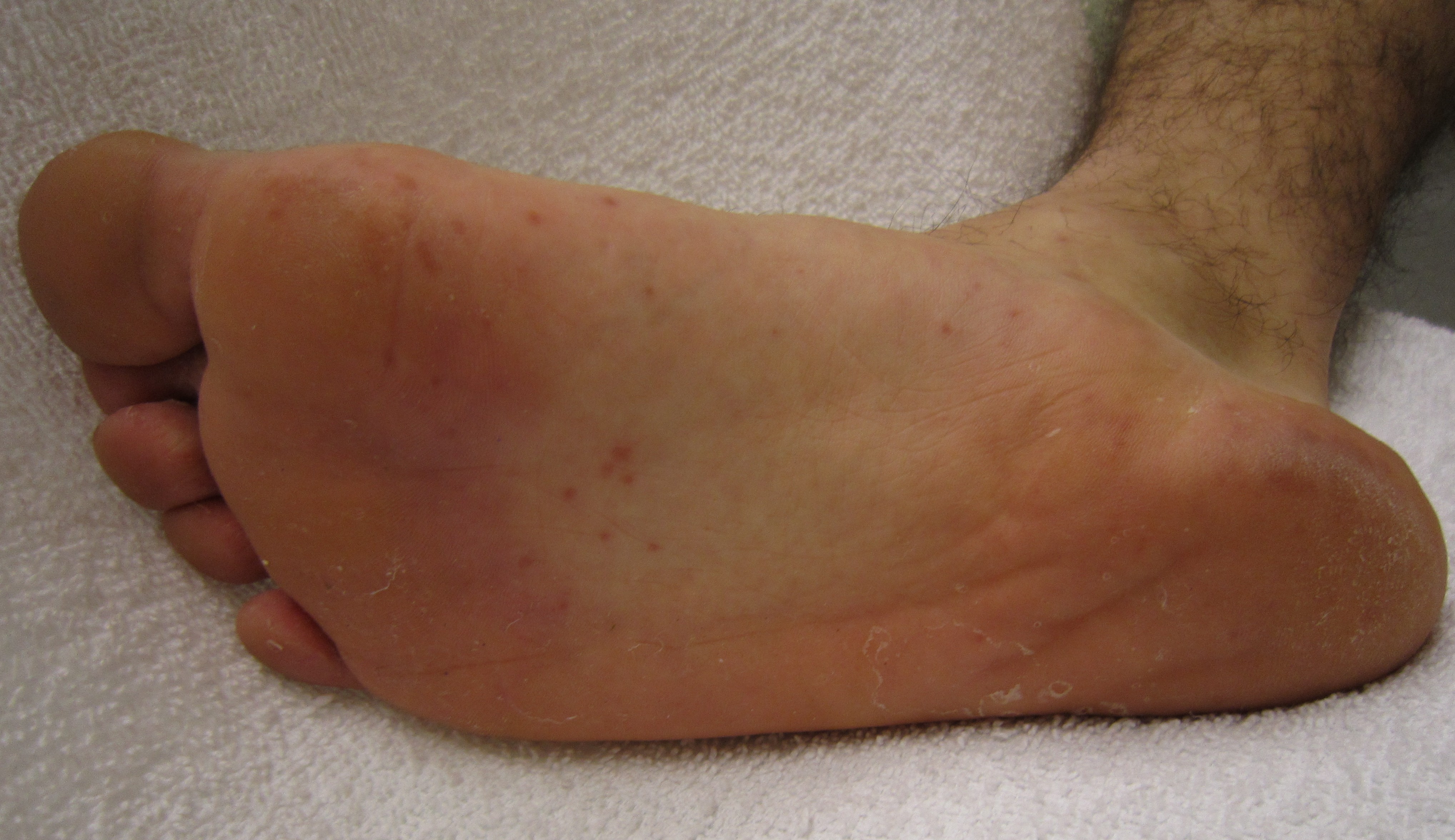 Characteristic_rash_of_hand,_foot,_and_mouth_disease,_on_a_human_foot.jpg