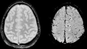 Compare SWI and GRE Trauma.png