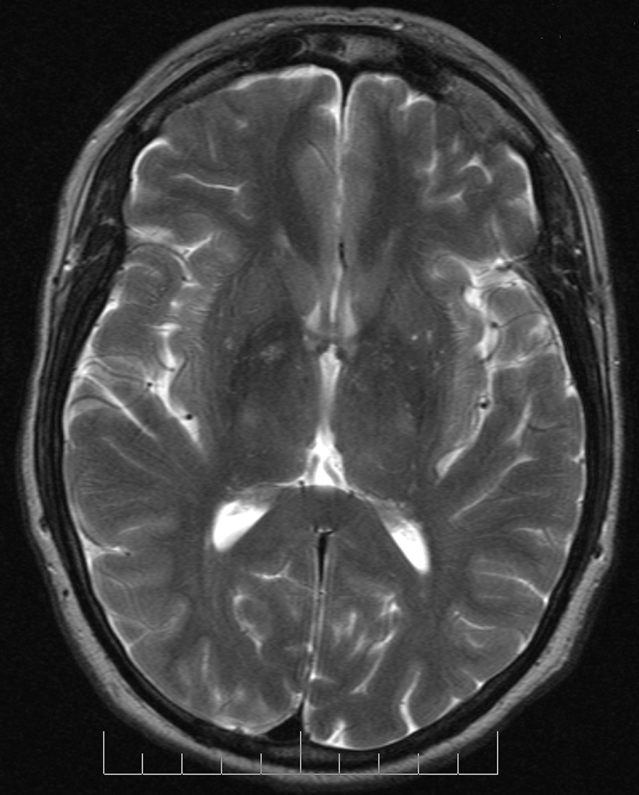 brain mri images