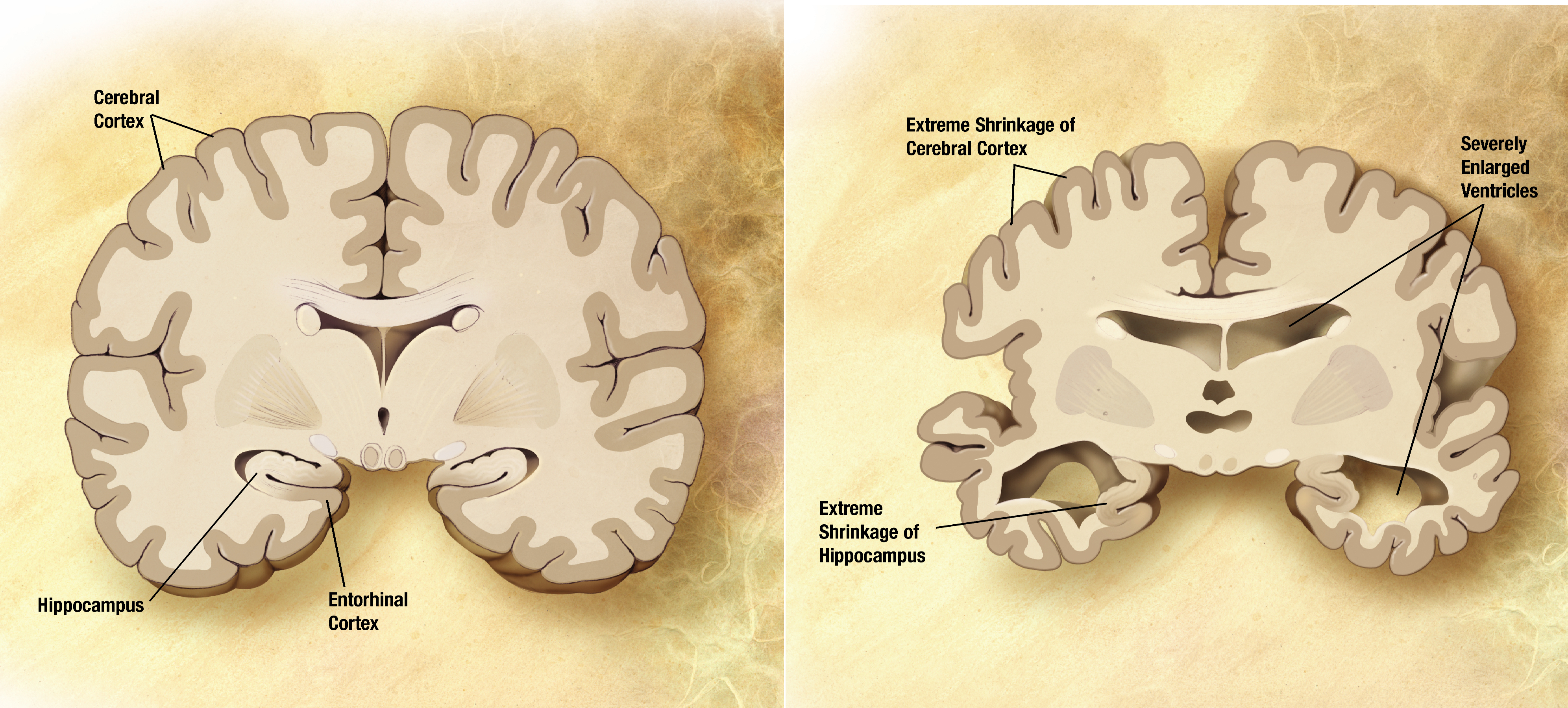 File:Alzheimer's disease brain comparison.jpg - Wikimedia Commons