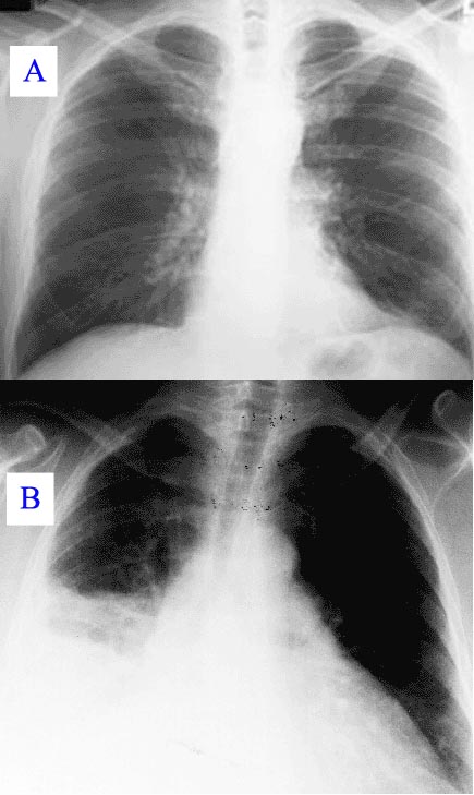 images of pneumonia