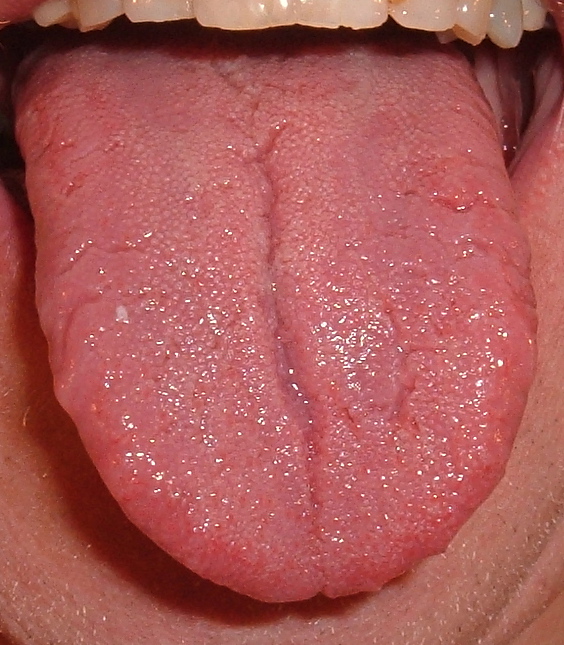 Tongue Cancer Symptoms