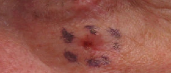 Basal Cell Carcinoma, left infraorbital cheek, marked for biopsy (Original Post: Shared in Basal-cell carcinoma)