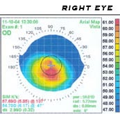 Corneal topogram of a keratoconic eye