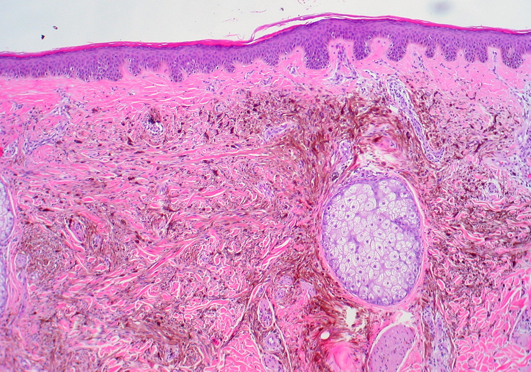 nevus histology