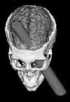 CGI image of rod piercing Phineas Gage's skull...