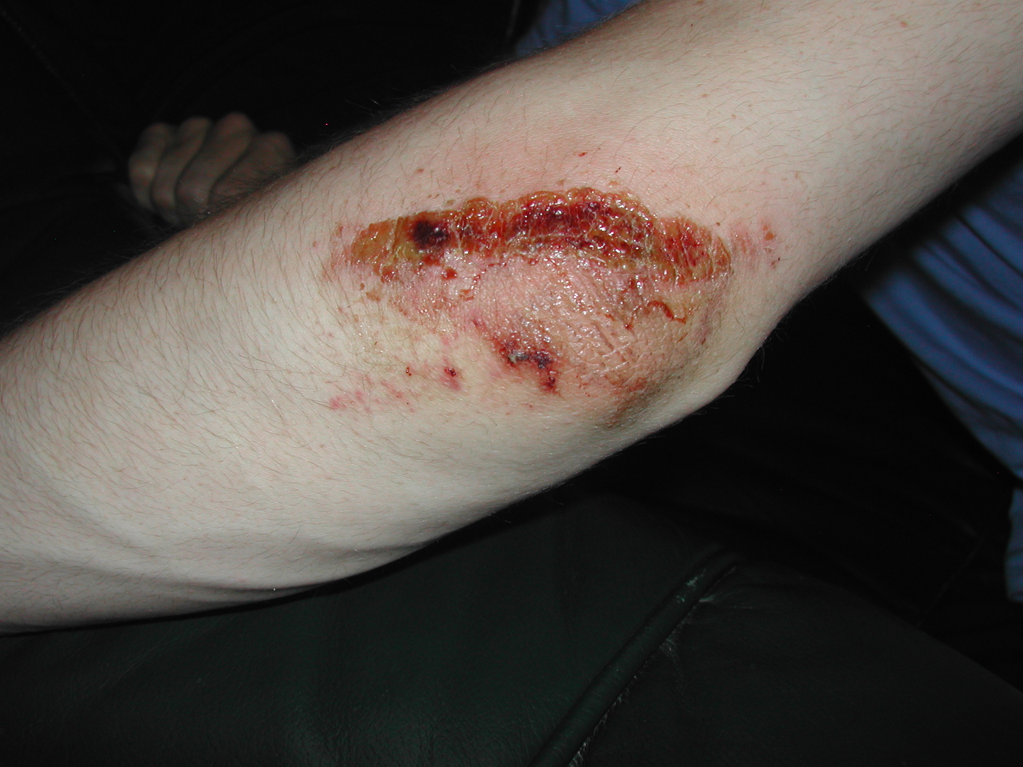 scab pictures