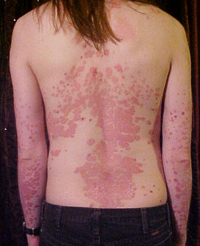 Red patches of psoriasis on back and elbows