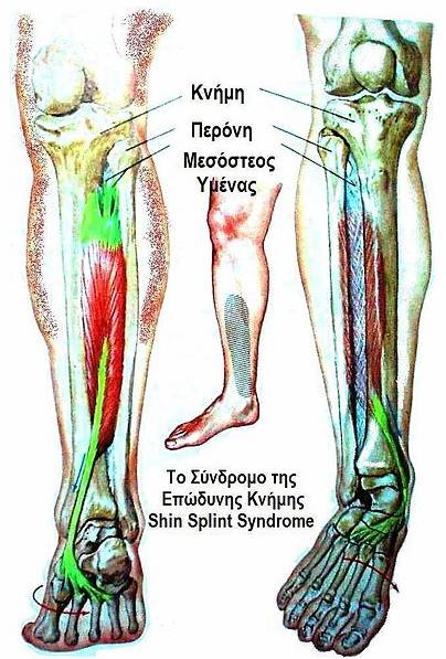 http://upload.wikimedia.org/wikipedia/commons/b/b3/Shin_Splint_Syndrome.jpg