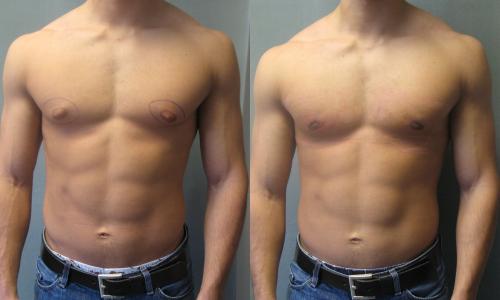 http://upload.wikimedia.org/wikipedia/commons/b/b7/Impending_Gynecomastia%2C_Puffy_Nipples.jpg