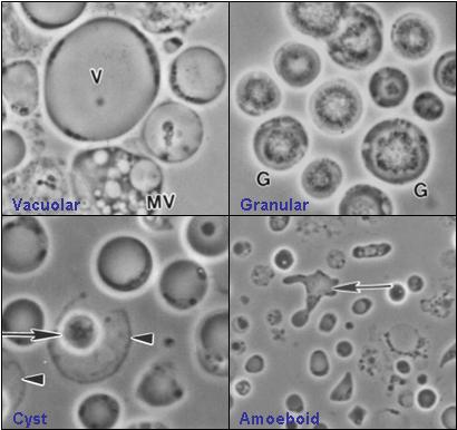 Four common forms of Blastocystis hominis. Clockwise from top left: vacuolar, granular, amoeboid, and cyst forms. Four common forms of Blastocystis hominis Valzn.jpg