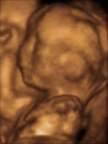 A 3D ultrasound taken of a fetus at 20 weeks.