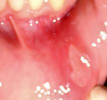 oral aphthae