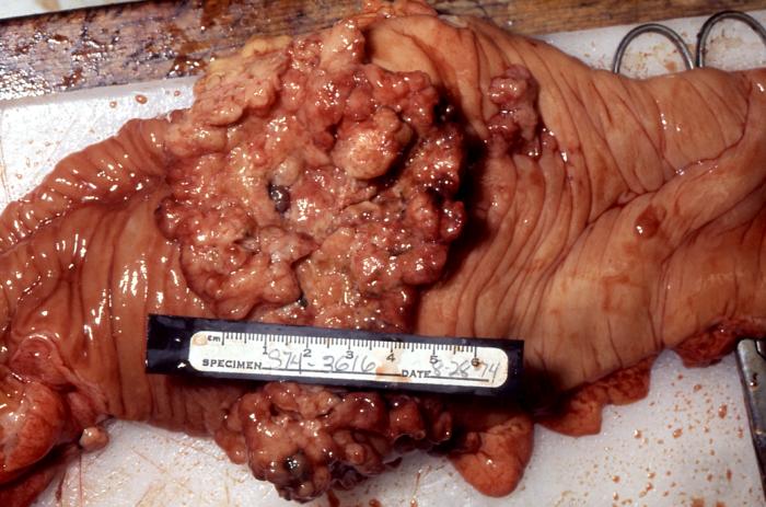 adenocarcinoma colon