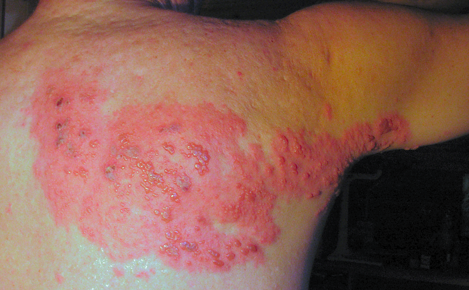 File:Herpes zoster chest.png