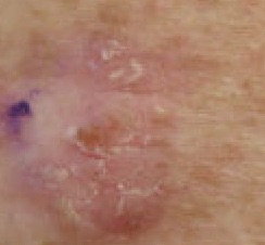 Actinic keratosis, left upper paraspinal back (Original Post: Shared in Actinic keratosis)