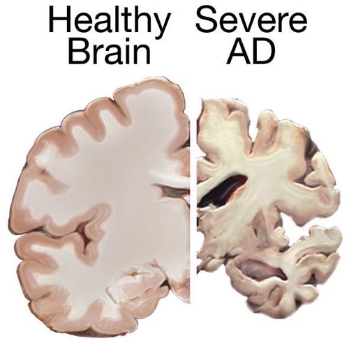 File:Alzheimers brain.jpg