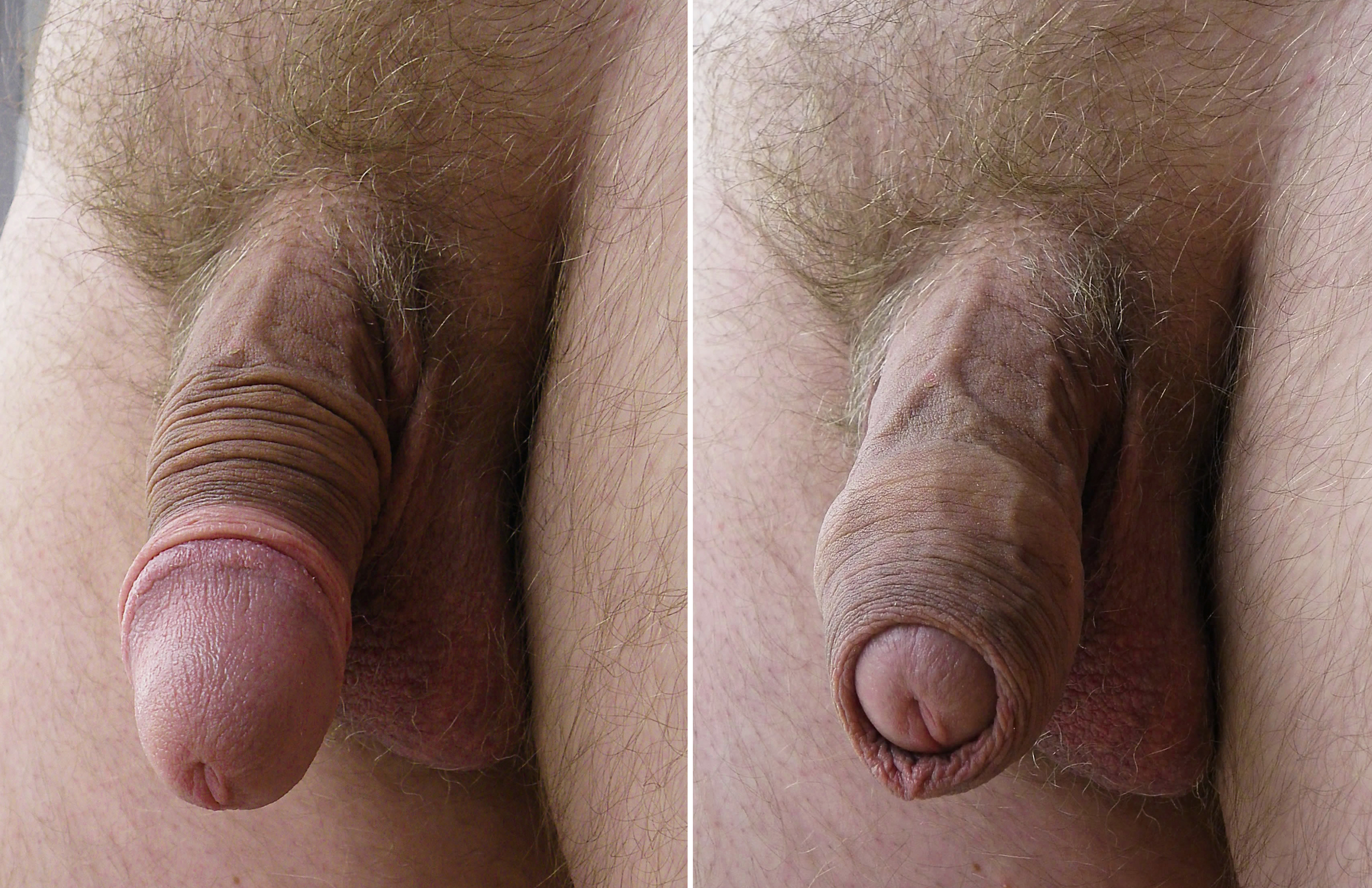 Imagefap mature foreskin