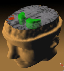 Brain section, Schizophrenia PET scan