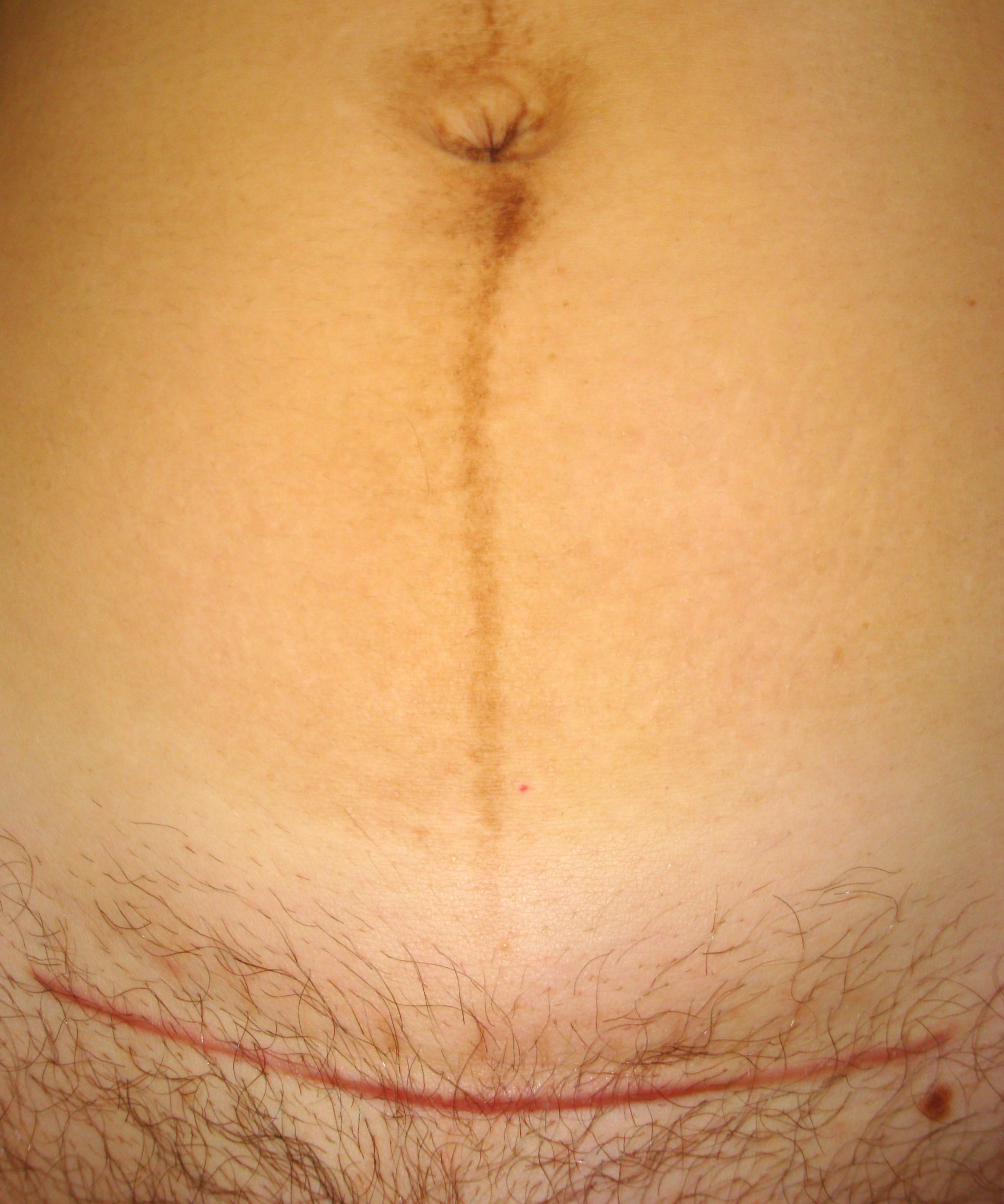 C-Section Scar