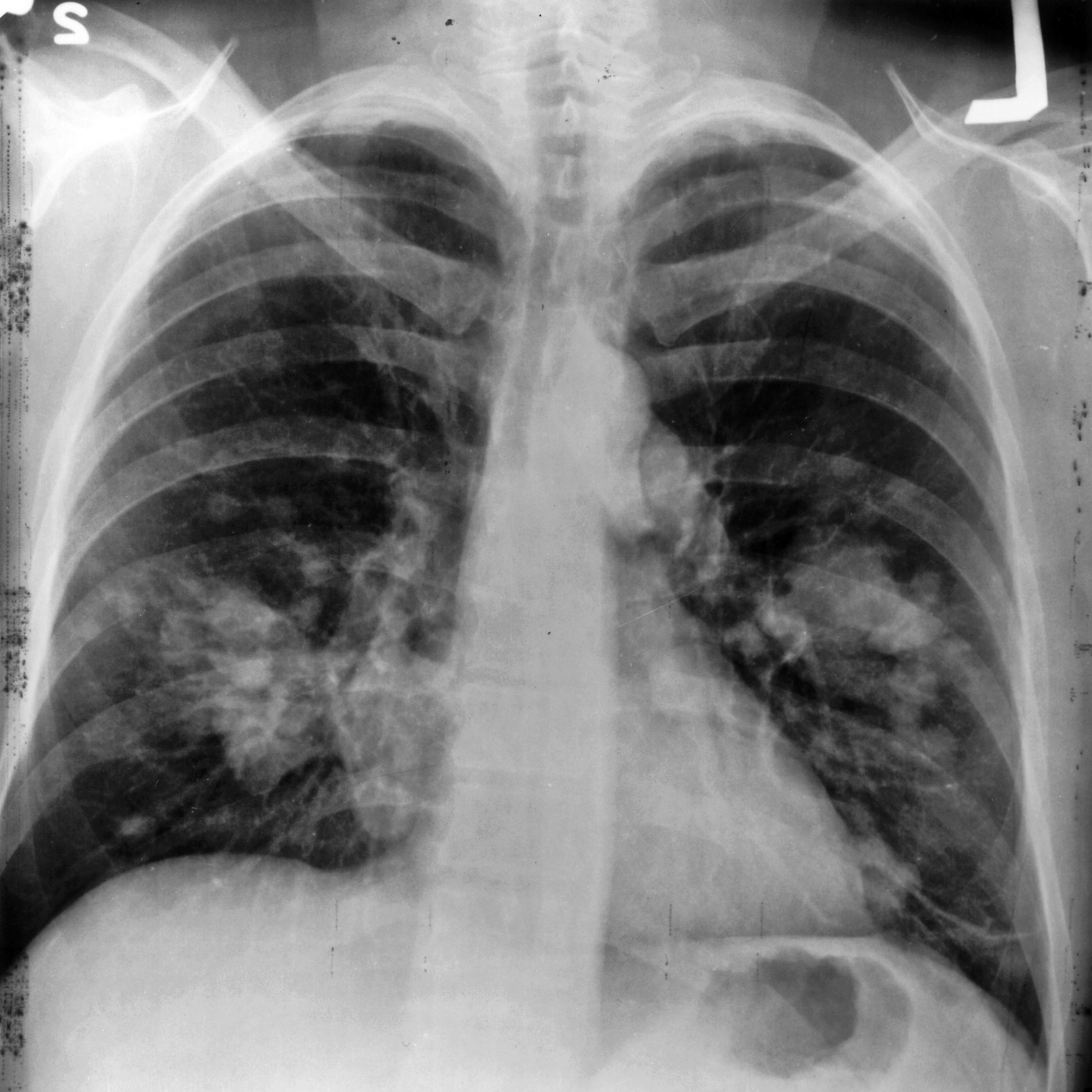 Chest XRay Lung Cancer
