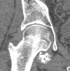 CT of synovial chondromatosis.[1]