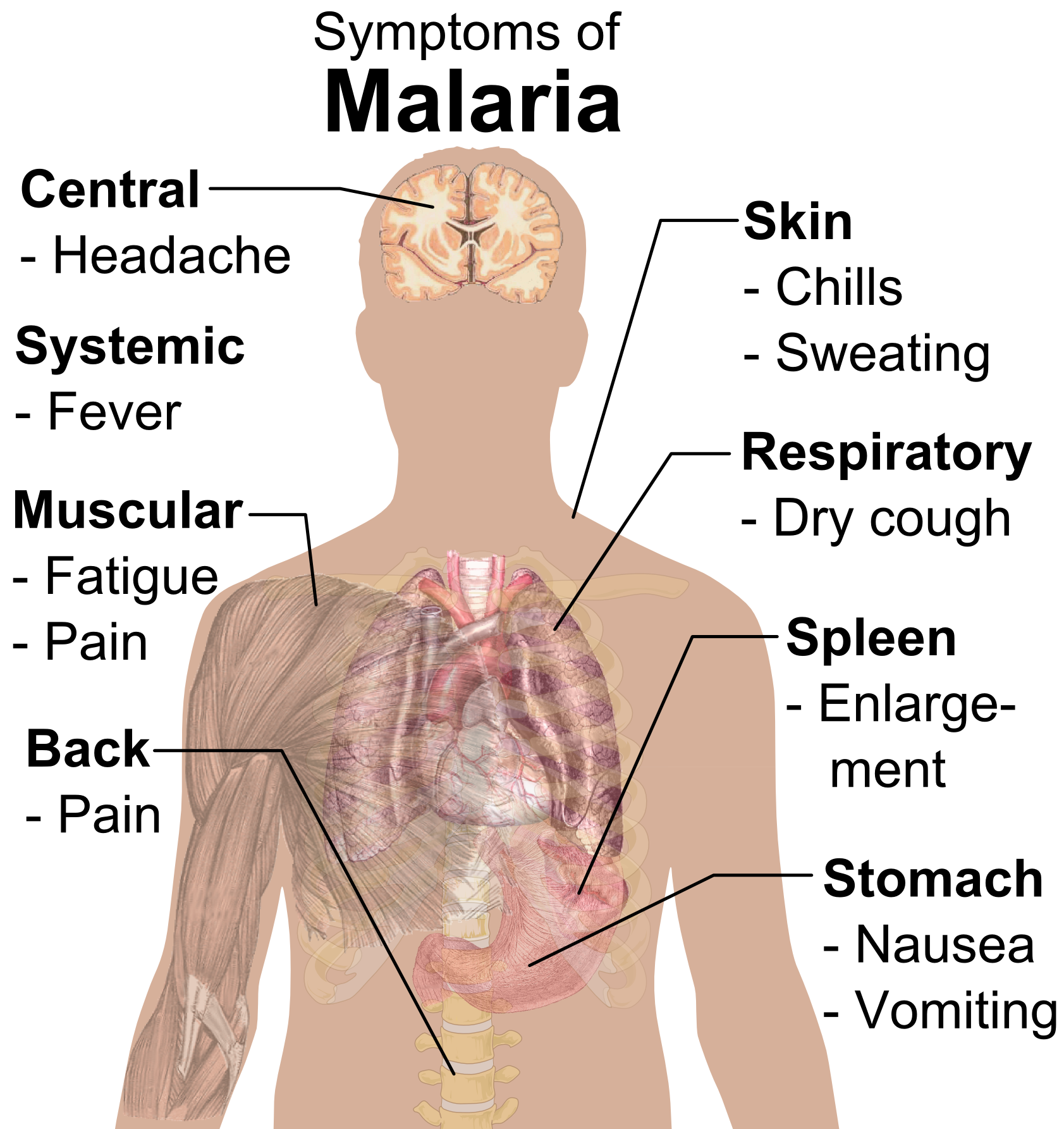 FileSymptoms of Malaria.png Wikipedia