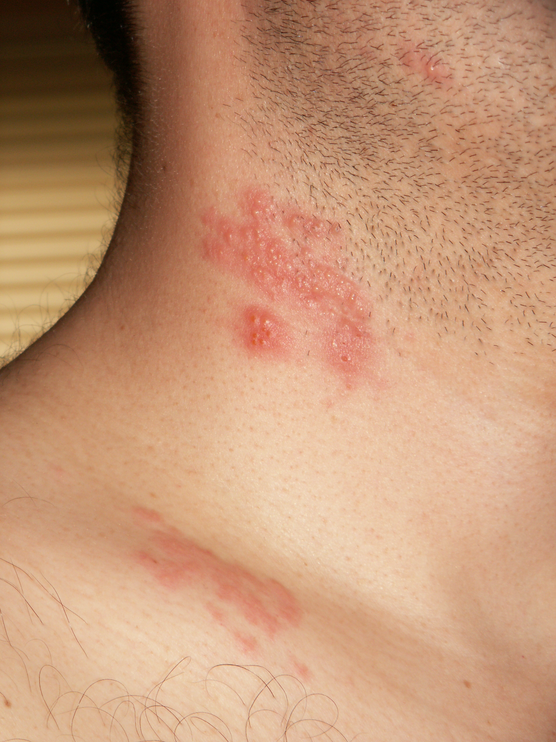 Herpes Rashes