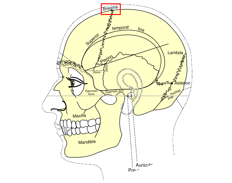  at least for a short time, if the superior sagittal sinus is torn.