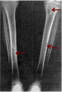 X-ray of a pair of human tibia, which run from the top right and left corner of the image into the bottom center, where they almost converge. Small gray blemishes, identified as brown tumors, can be seen at the top and halfway down the right tibia and about three-quarters down the length of the left tibia.