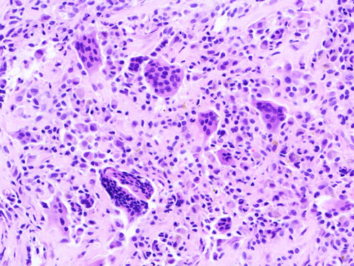 Giant Cell Glioblastoma