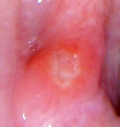 Aphthous ulcer in the back of the mouth