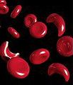 Sickle cells characterize sickle cell anemia, ...