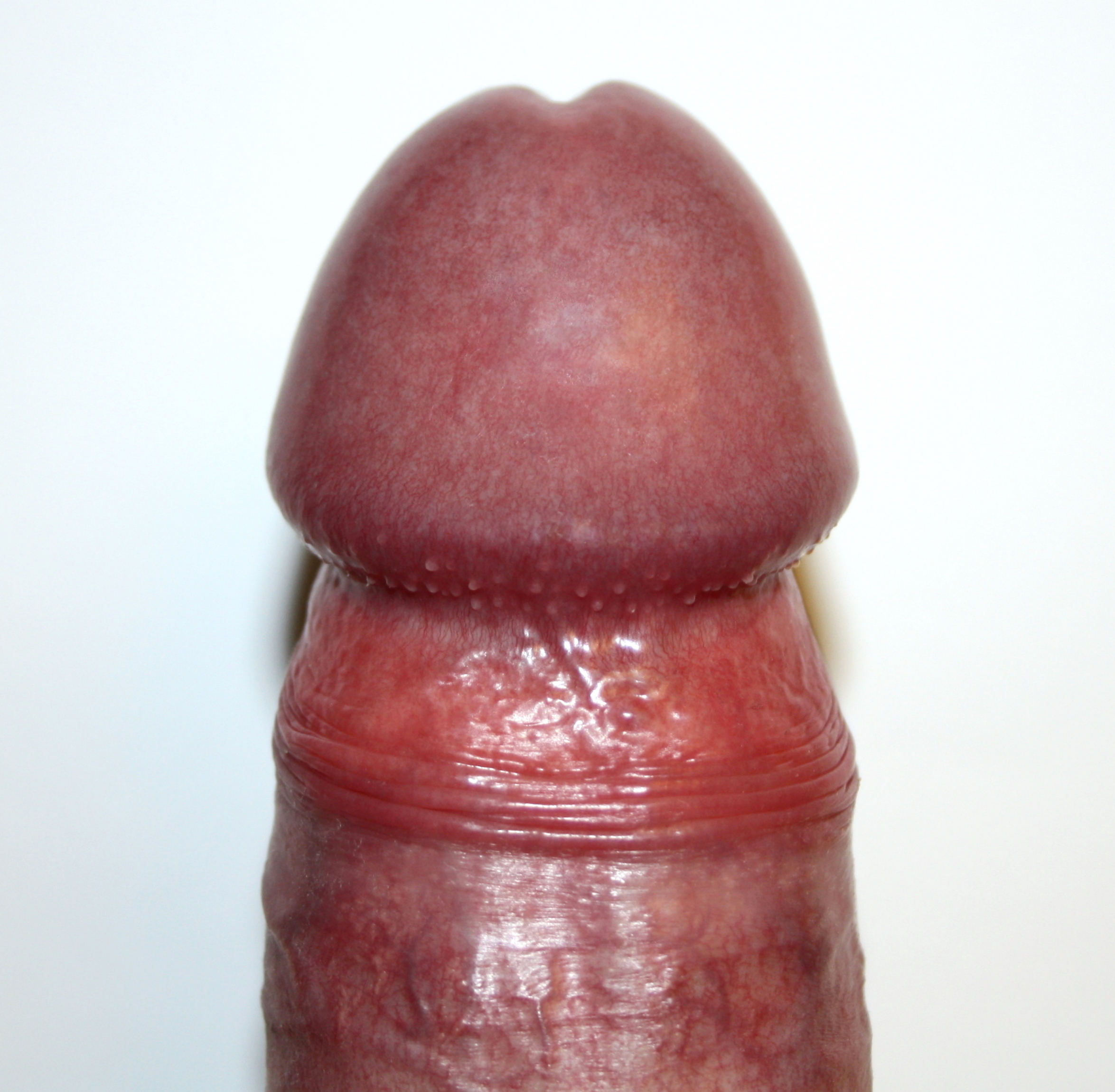 Pearly Penile Papules